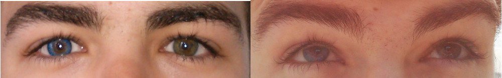 Augen mit einer Farblinse